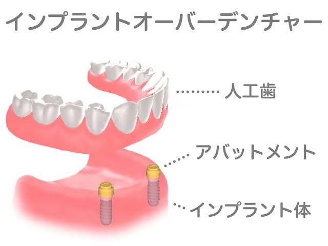 インプラントオーバーデンチャー