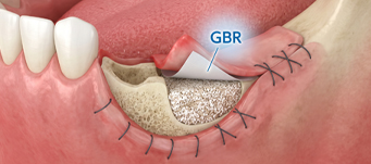 GBR（骨誘導再生法）のイメージ画像