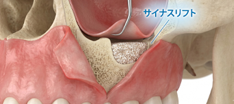 サイナスリフトのイメージ画像