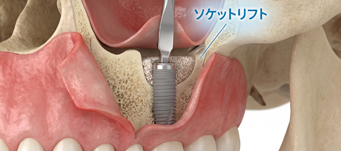 ソケットリフトのイメージ画像