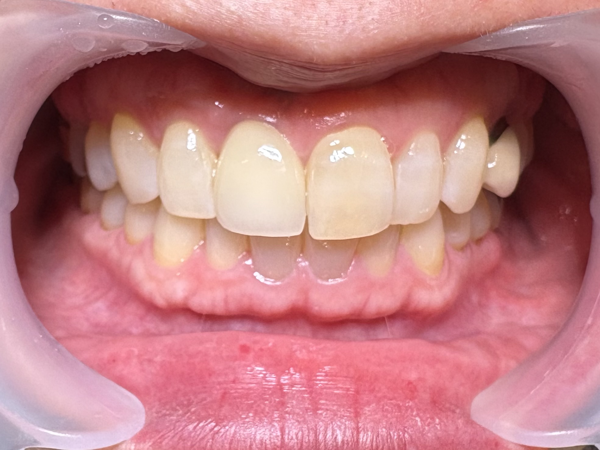 さいたまでのインプラント無料相談について