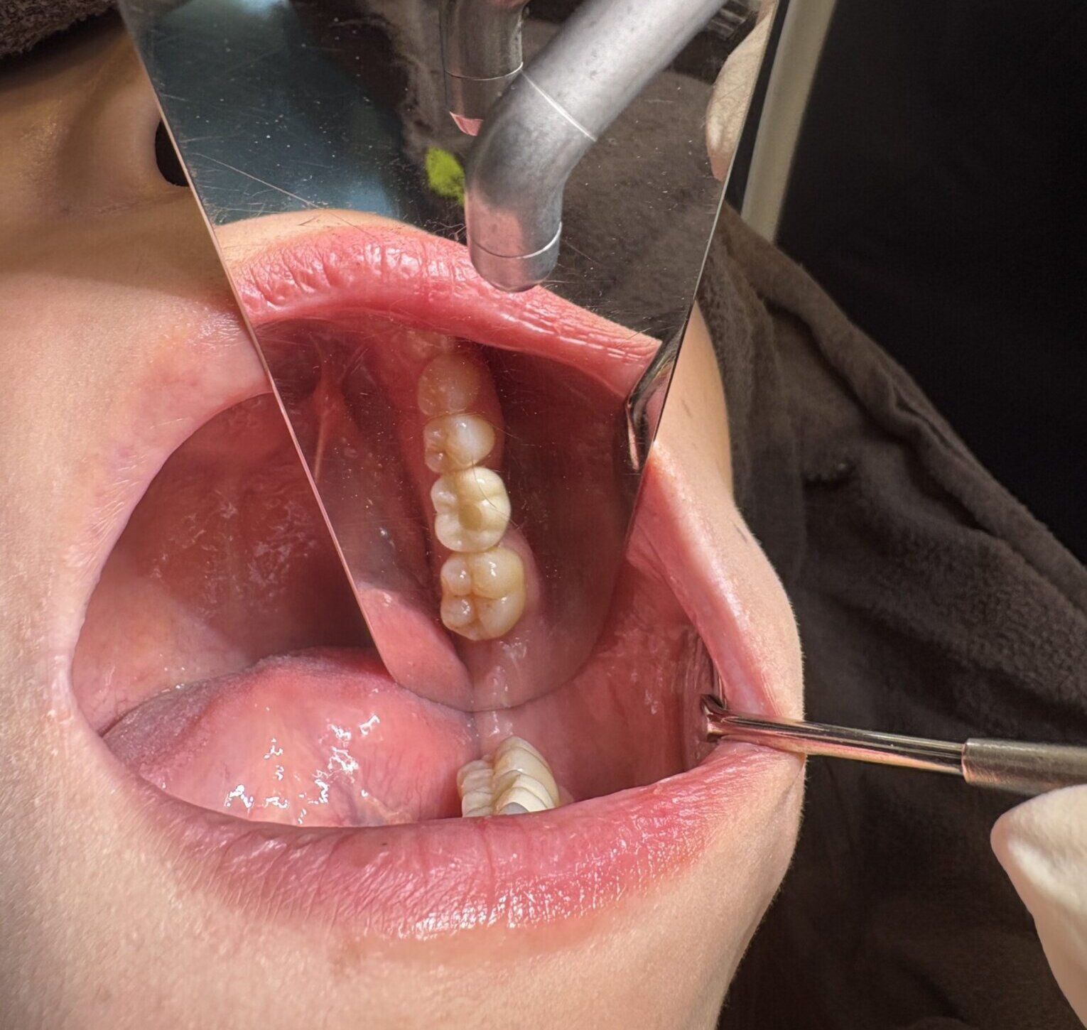 さいたま市のインプラント治療｜ストローマンインプラント症例