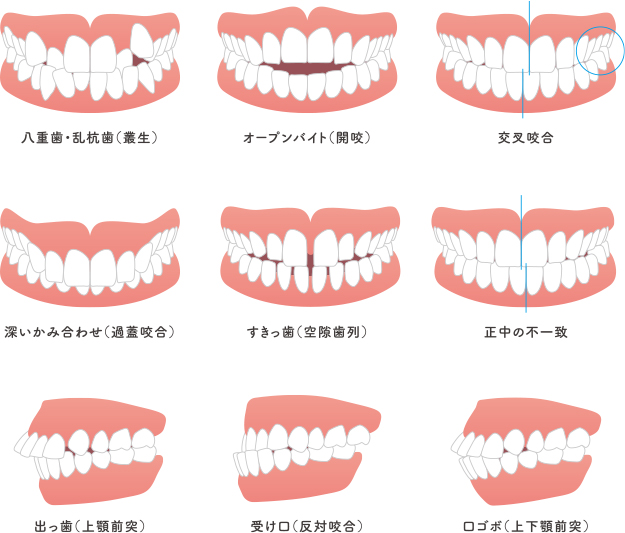 不正咬合の種類